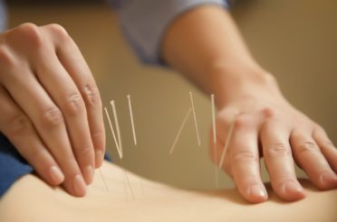 Acupuncture for Back Pain – What you Need to Know
