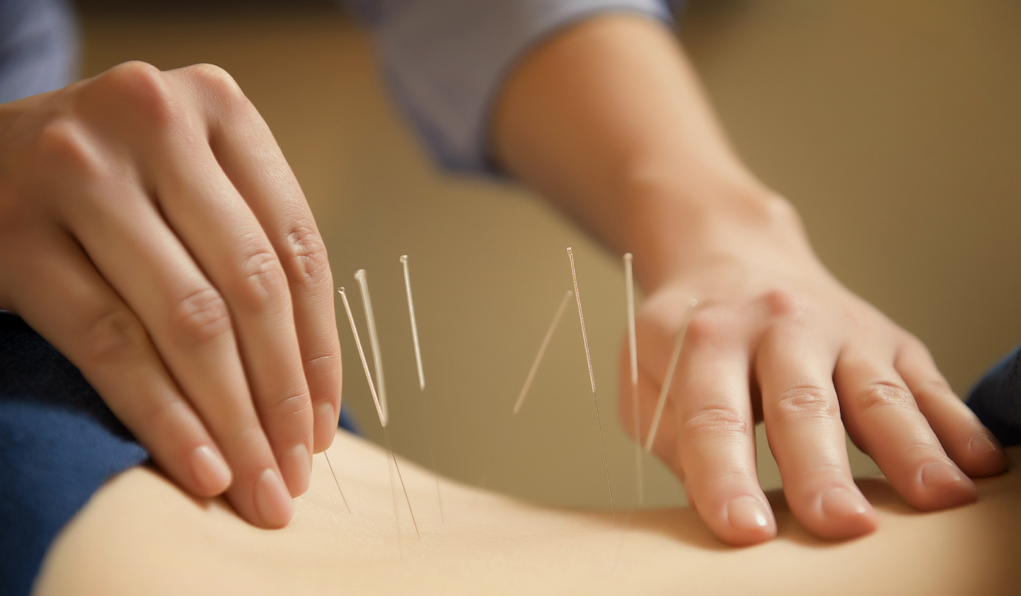 Acupuncture for Back Pain - What you Need to Know - Neotech Care
